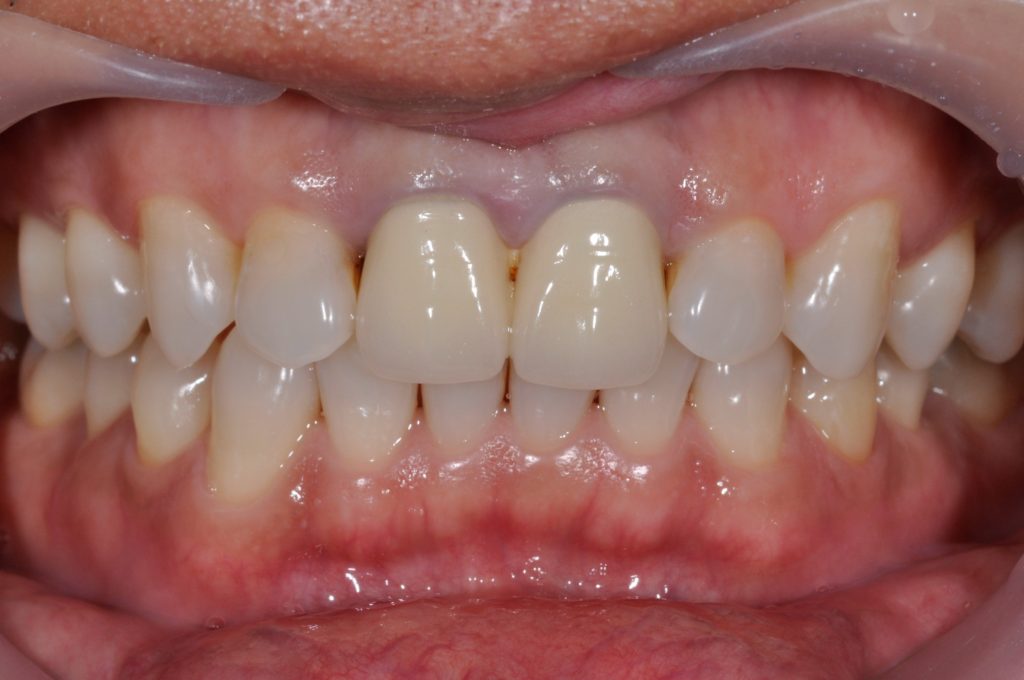 前牙全瓷牙套替換a 全方位牙齒美學權威 張智洋醫師