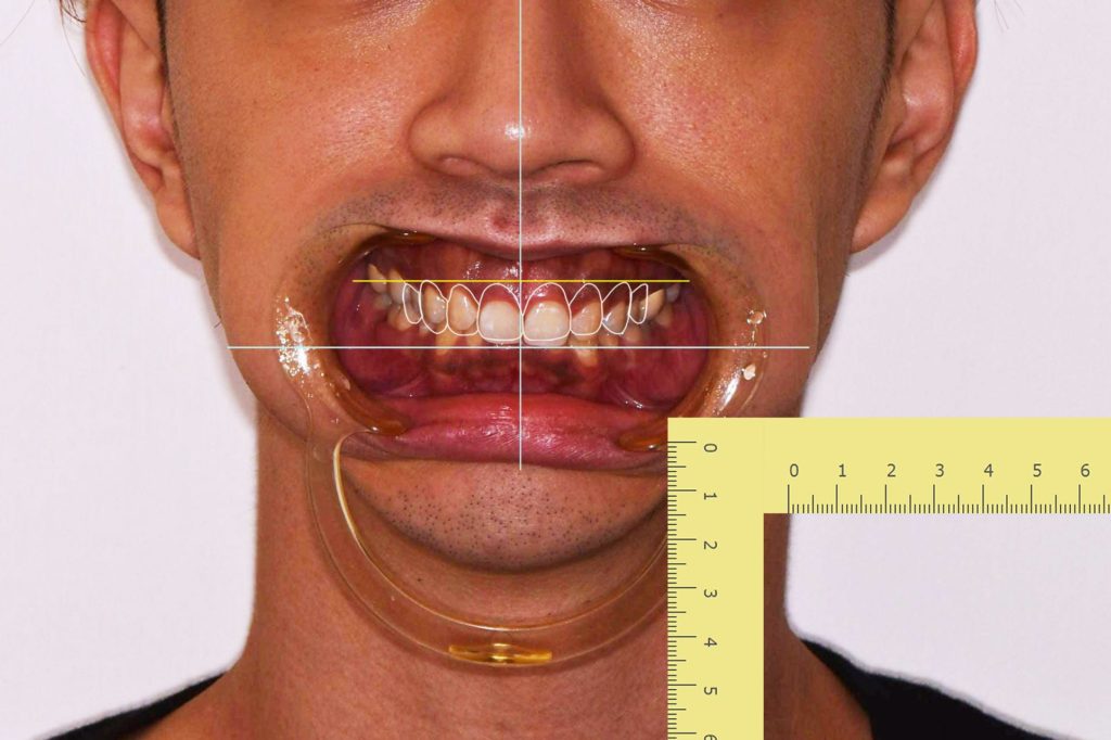 打造個性化的前牙美學h - 張智洋醫師 全方位牙齒美學權威