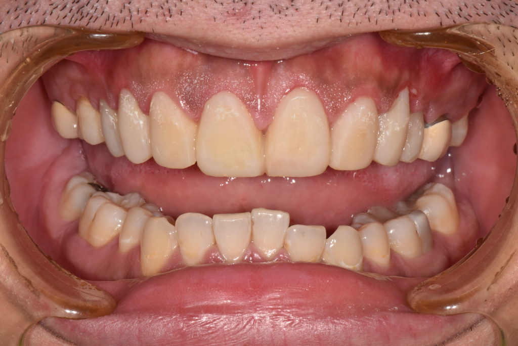 打造個性化的前牙美學k - 張智洋醫師 全方位牙齒美學權威