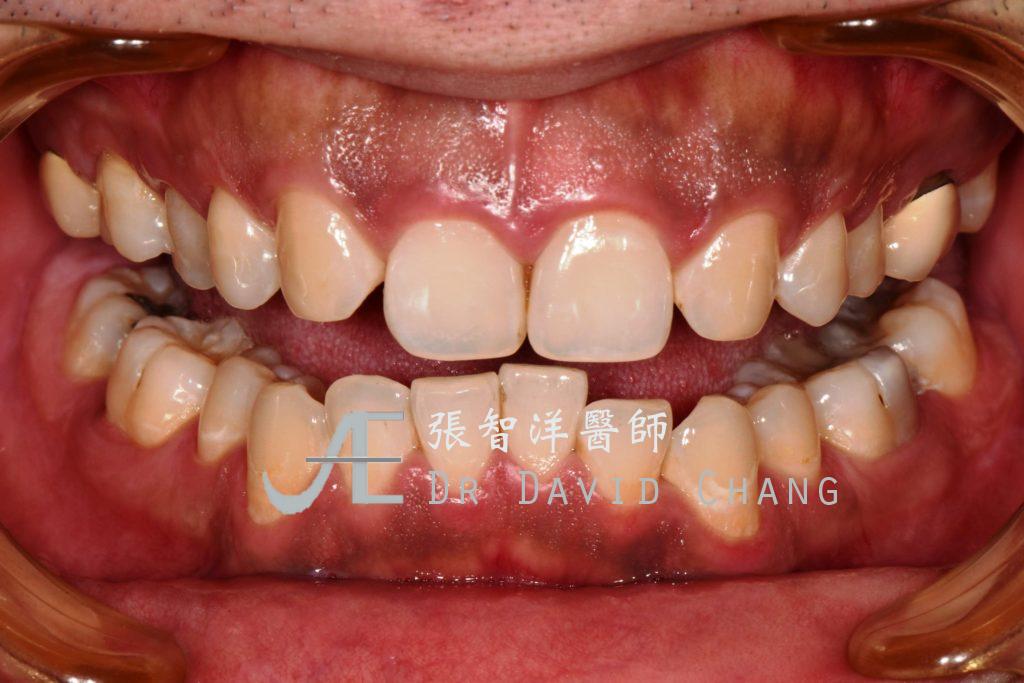 打造個性化的前牙美學t - 張智洋醫師 全方位牙齒美學權威