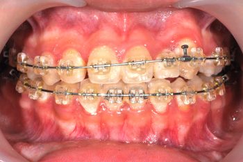 牙齒矯正案例2d 全方位牙齒美學權威 張智洋醫師