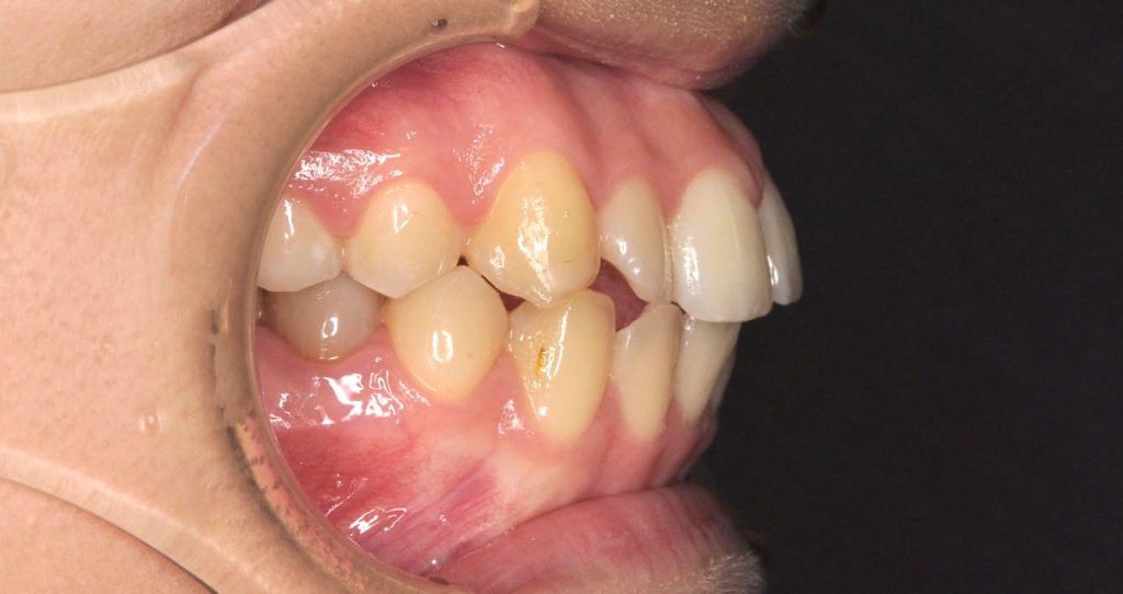 牙齒矯正案例3f 全方位牙齒美學權威 張智洋醫師
