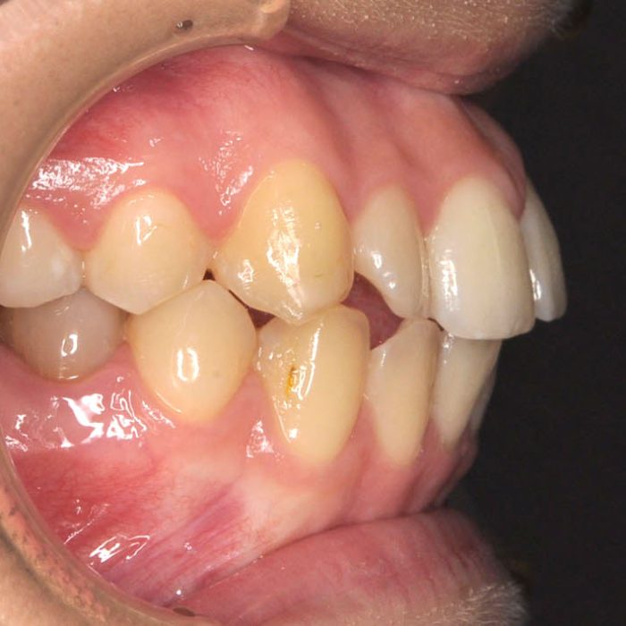 牙齒矯正案例3f 全方位牙齒美學權威 張智洋醫師