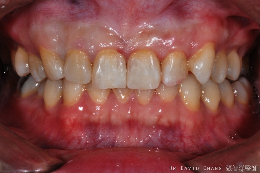 陶瓷貼片案例3 側門牙，虎牙d 全方位牙齒美學權威 張智洋醫師