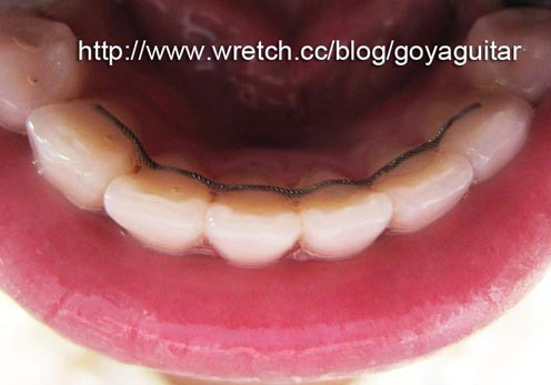 【部落客GOYA—矯正後的固定器】b - 全方位牙齒美學權威 張智洋醫師