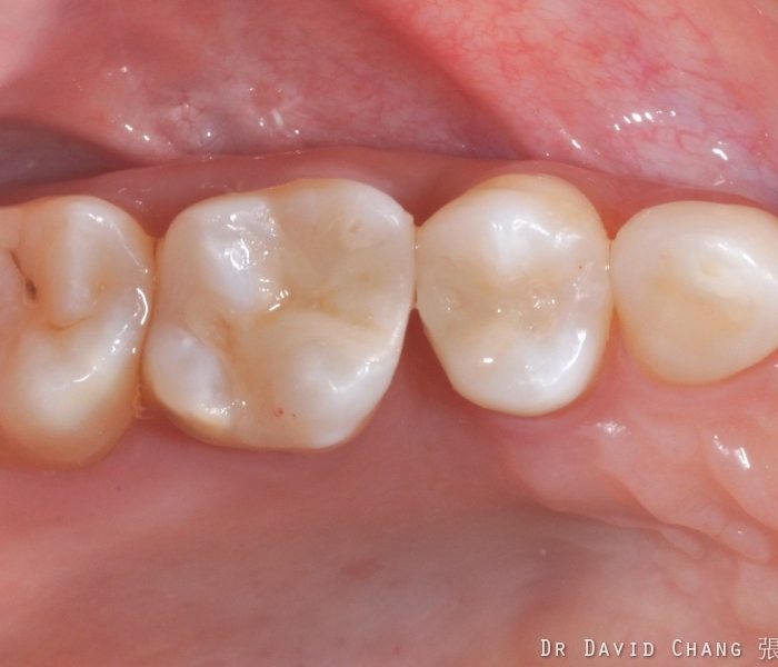 3D齒雕 多顆後牙 2 - 全方位牙齒美學權威 張智洋醫師