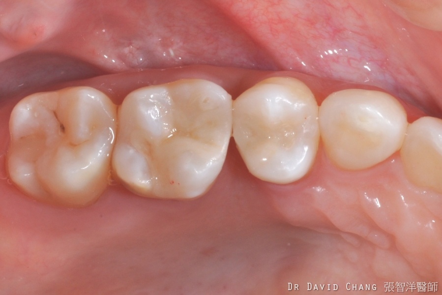 3D齒雕 多顆後牙 2 - 全方位牙齒美學權威 張智洋醫師