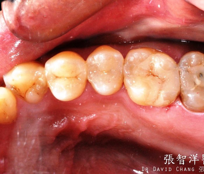 3D齒雕 多顆後牙 - 全方位牙齒美學權威 張智洋醫師