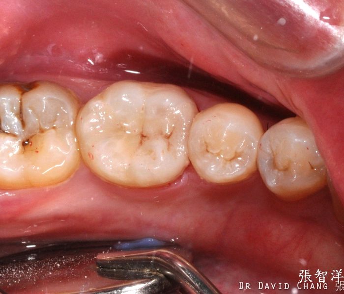 3D齒雕 大臼齒 2 - 全方位牙齒美學權威 張智洋醫師