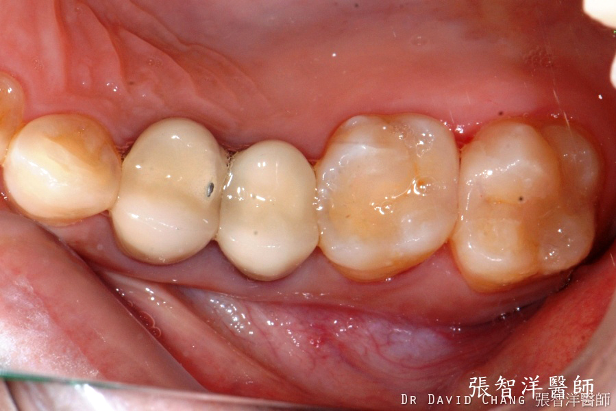 3D齒雕 大臼齒 3 - 全方位牙齒美學權威 張智洋醫師