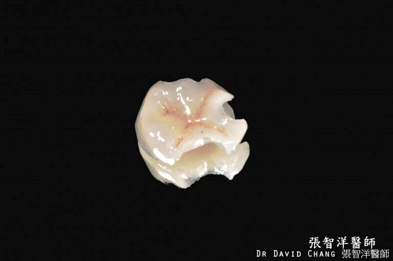 3D齒雕 大臼齒 4 - 全方位牙齒美學權威 張智洋醫師