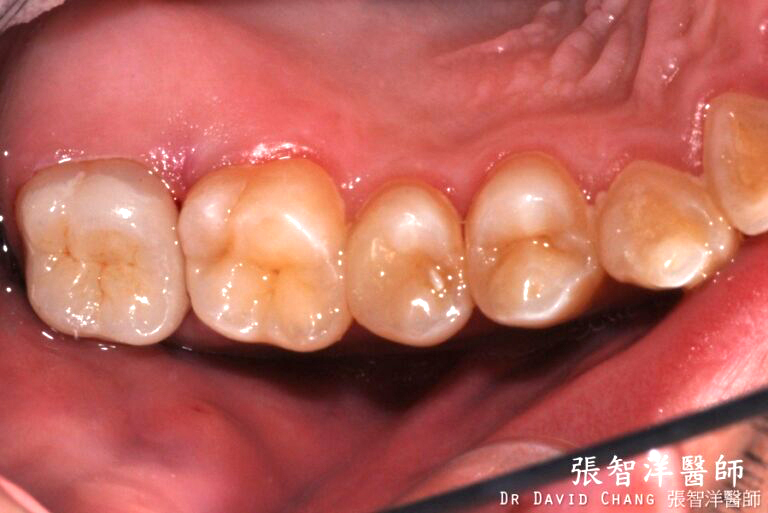 3D齒雕 大臼齒 6 - 全方位牙齒美學權威 張智洋醫師