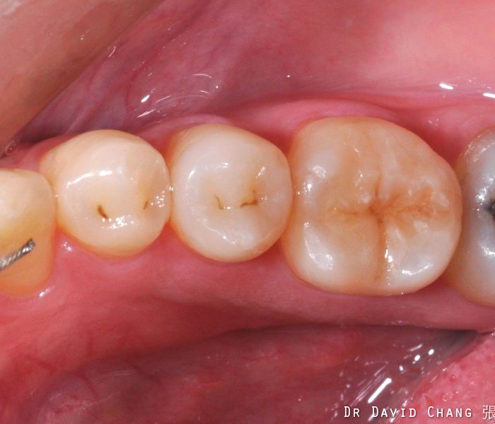 3D齒雕 大臼齒 7 - 全方位牙齒美學權威 張智洋醫師