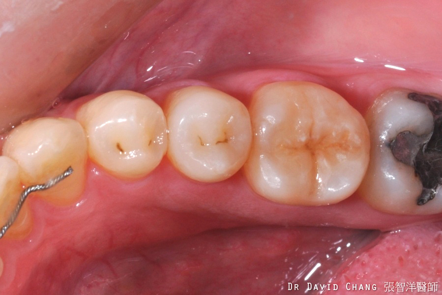 3D齒雕 大臼齒 7 - 全方位牙齒美學權威 張智洋醫師