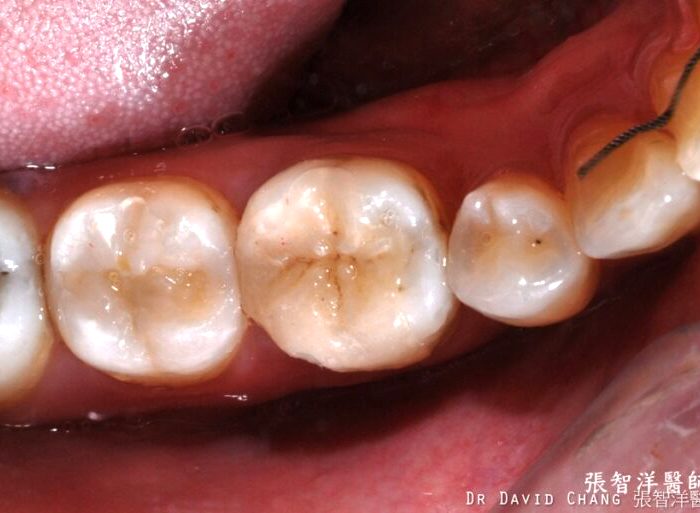 3D齒雕 大臼齒 - 全方位牙齒美學權威 張智洋醫師