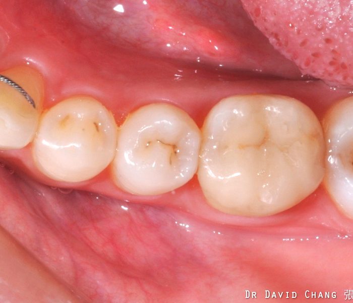 3D齒雕 大臼齒 8 - 全方位牙齒美學權威 張智洋醫師