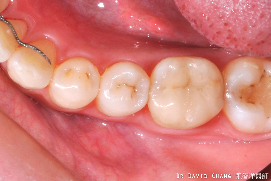 3D齒雕 大臼齒 8 - 全方位牙齒美學權威 張智洋醫師