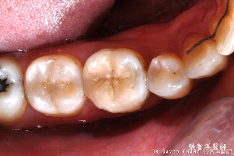3D齒雕 大臼齒 - 全方位牙齒美學權威 張智洋醫師