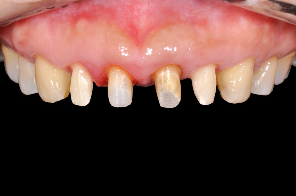 修磨過後的牙齒 全瓷冠與傳統假牙比較-張智洋醫師-全方位植牙美學權威