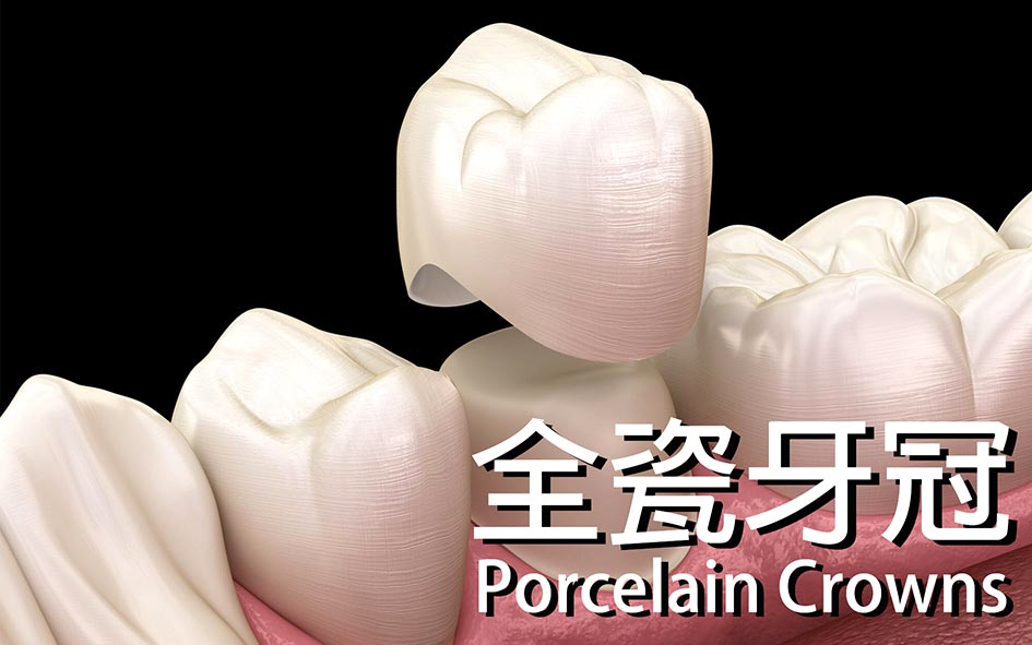 Porcelain-Crowns-全瓷牙冠案例-全方位牙齒美學權威-張智洋醫師