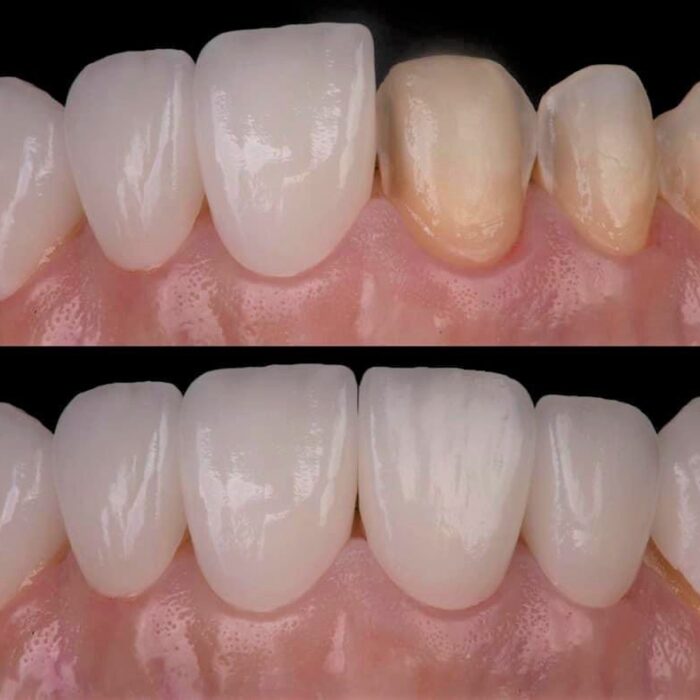 陶瓷美白貼片 Porcelain Veneers - 全方位牙齒美學權威 張智洋醫師