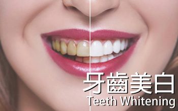 Tooth-Whitening-牙齒美白-全方位牙齒美學權威-張智洋醫師