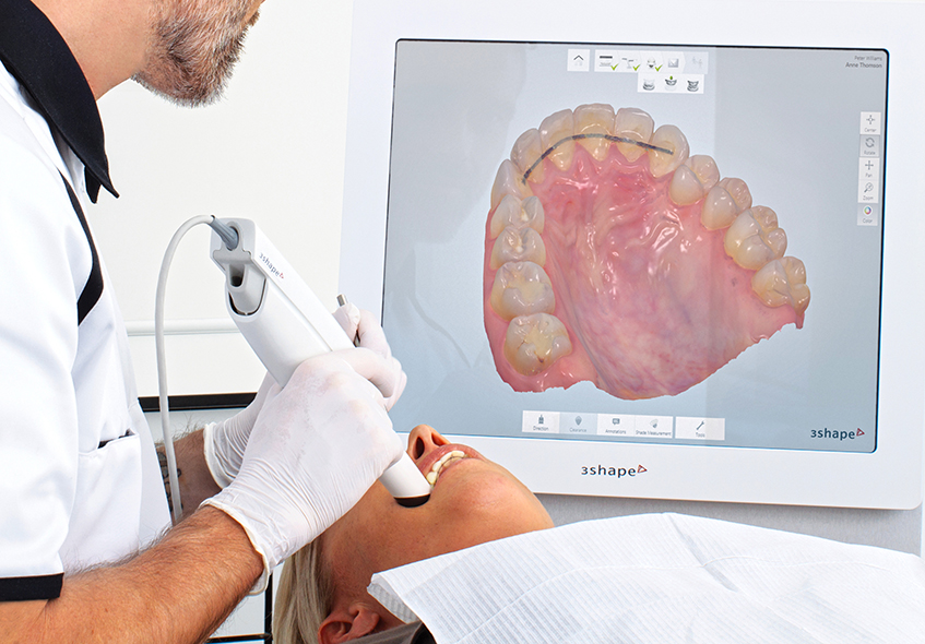 intra-oral-scanner口掃機取印模1 張智洋醫師