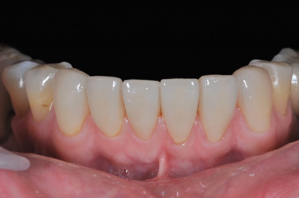 下顎前牙全瓷貼片 - 全方位牙齒美學權威 張智洋醫師