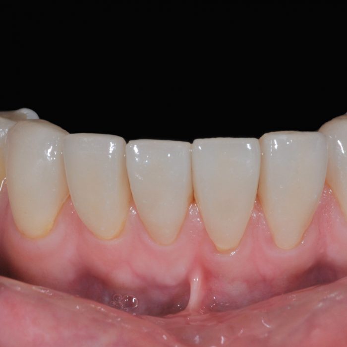 下顎前牙全瓷貼片 - 全方位牙齒美學權威 張智洋醫師
