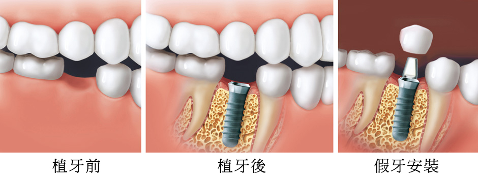 人工植牙 Dental Implant