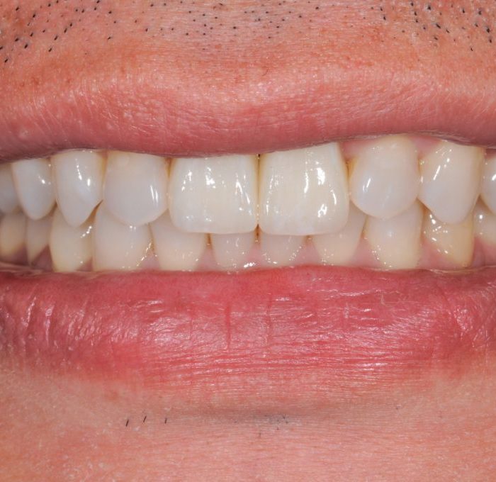 前牙全瓷牙套替換 - 全方位牙齒美學權威 張智洋醫師