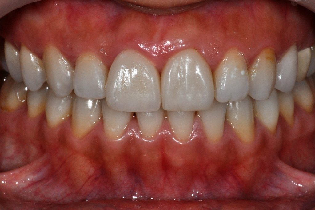 前牙美學案例 - 全方位牙齒美學權威 張智洋醫師