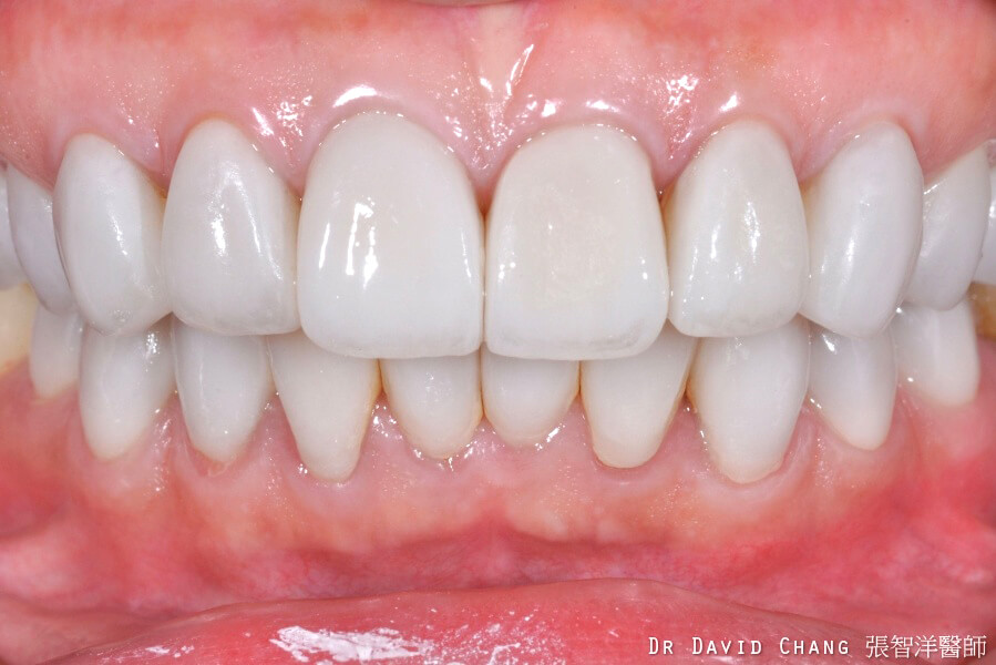 四環黴素陶瓷貼片處理 - 全方位牙齒美學權威 張智洋醫師