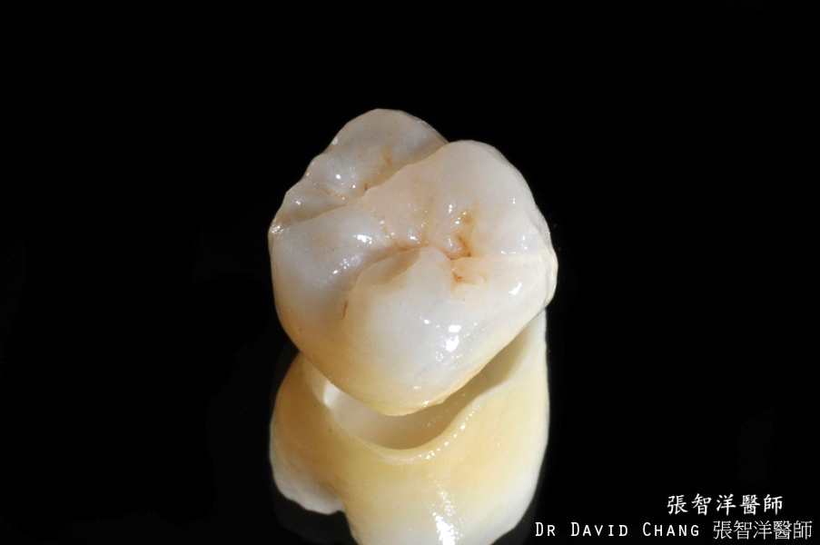 大臼齒 全瓷冠 - 全方位牙齒美學權威 張智洋醫師