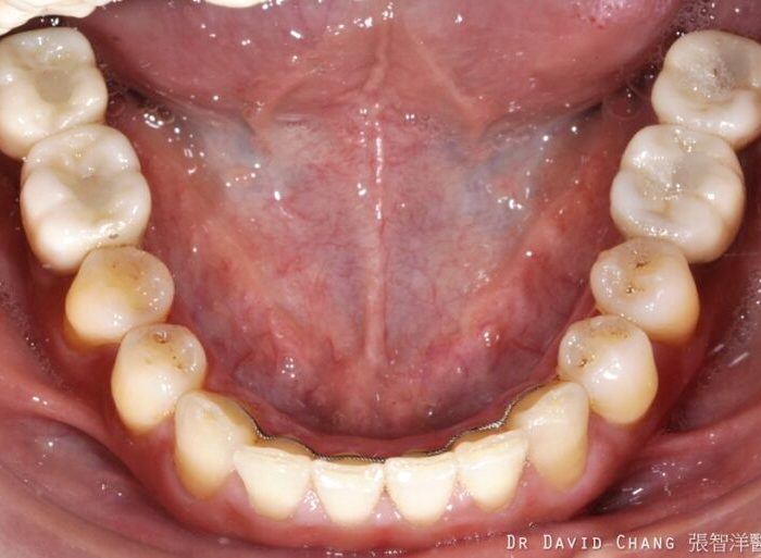 大臼齒植牙 x4 - 全方位牙齒美學權威 張智洋醫師