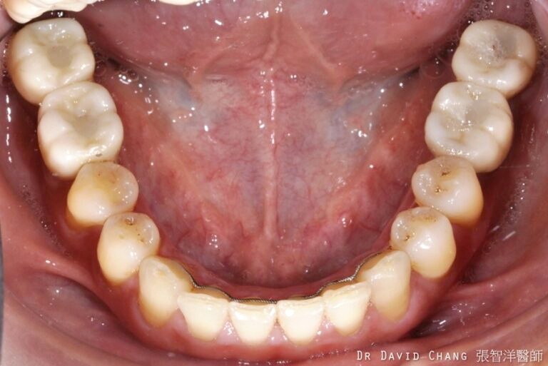 大臼齒植牙 x4 - 全方位牙齒美學權威 張智洋醫師