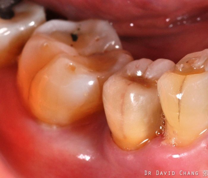 小臼齒植牙-張智洋醫師-全方位植牙美學權威