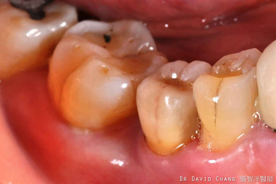 小臼齒植牙-張智洋醫師-全方位植牙美學權威