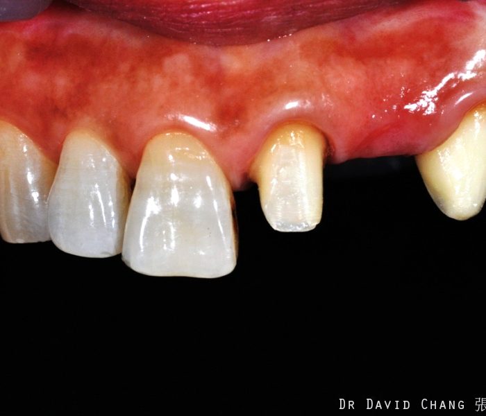 牙根美白 案例5 - 全方位牙齒美學權威 張智洋醫師