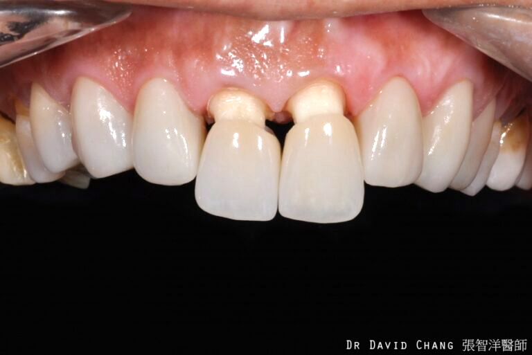 牙根美白 案例1 - 全方位牙齒美學權威 張智洋醫師
