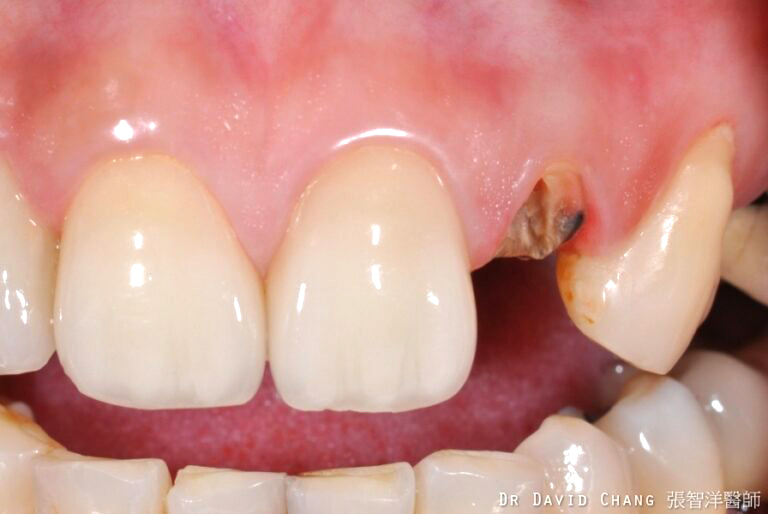牙根美白 案例2 - 全方位牙齒美學權威 張智洋醫師