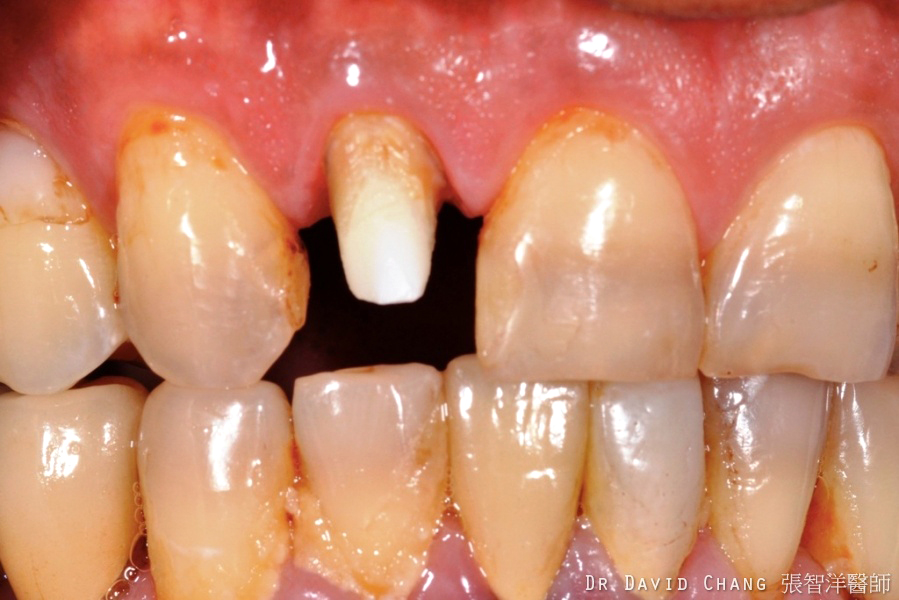 牙根美白 案例3 - 全方位牙齒美學權威 張智洋醫師