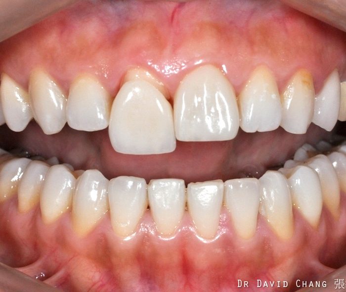 牙根美白 案例4 - 全方位牙齒美學權威 張智洋醫師