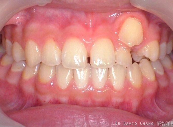 牙齒矯正案例2 - 全方位牙齒美學權威 張智洋醫師