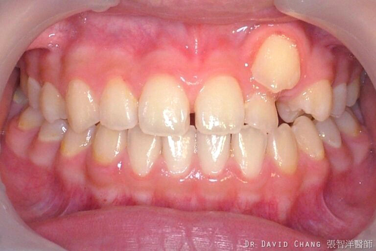 牙齒矯正案例2 - 全方位牙齒美學權威 張智洋醫師