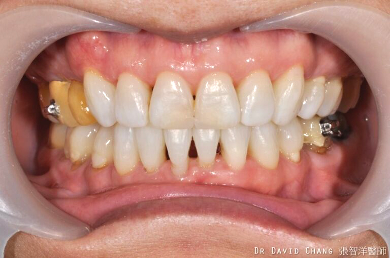 牙齒美白 案例1 - 全方位牙齒美學權威 張智洋醫師