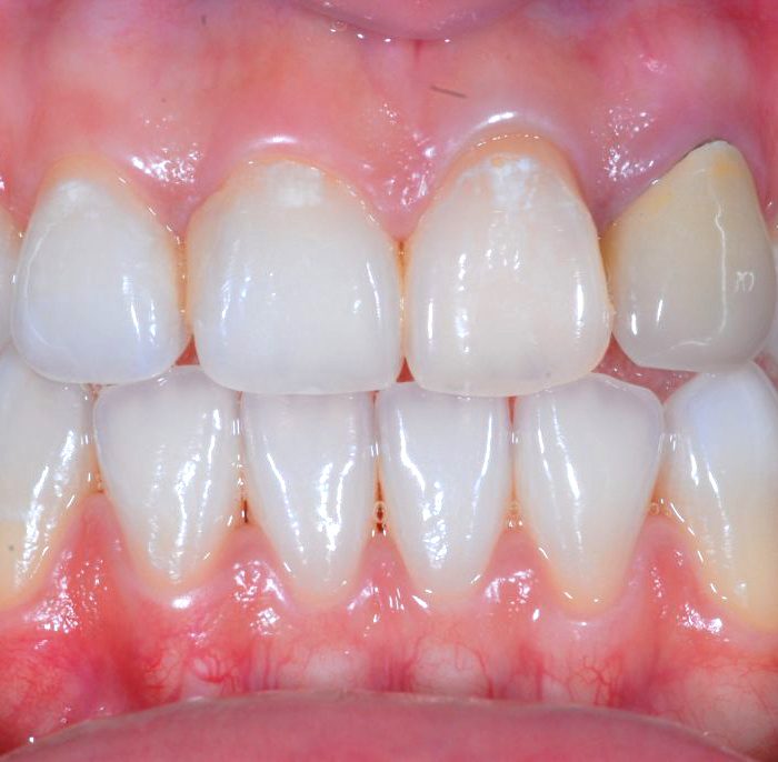 牙齒美白 案例2 - 全方位牙齒美學權威 張智洋醫師