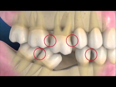 缺牙造成咬合高度喪失3 顳顎關節症候群- 全方位牙齒美學權威 張智洋醫師