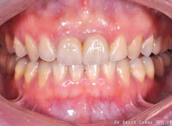 門牙全瓷冠 - 全方位牙齒美學權威 張智洋醫師
