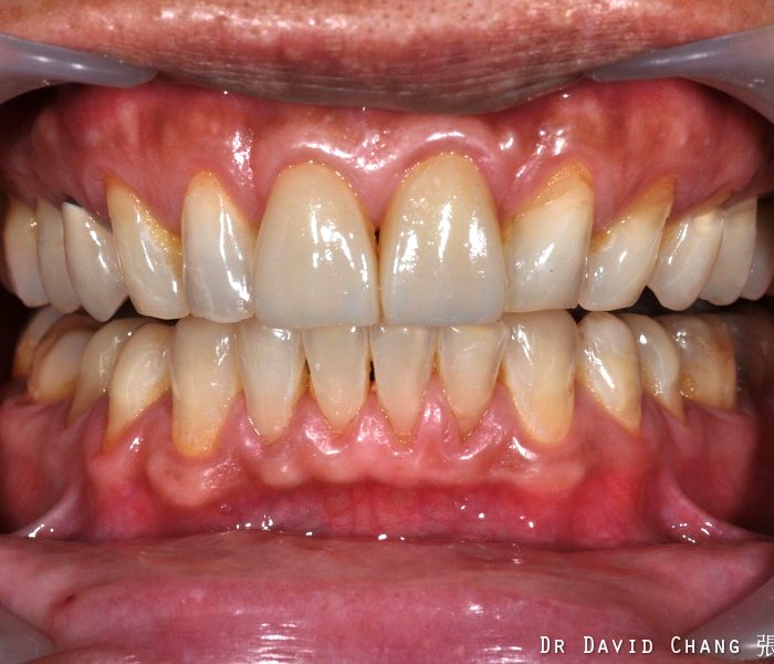 門牙陶瓷貼片 - 全方位牙齒美學權威 張智洋醫師
